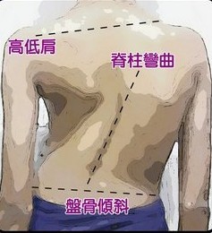 脊柱侧弯症状
