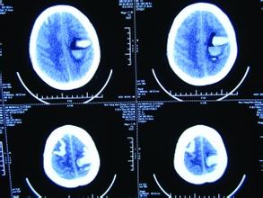 脑出血病因的护理