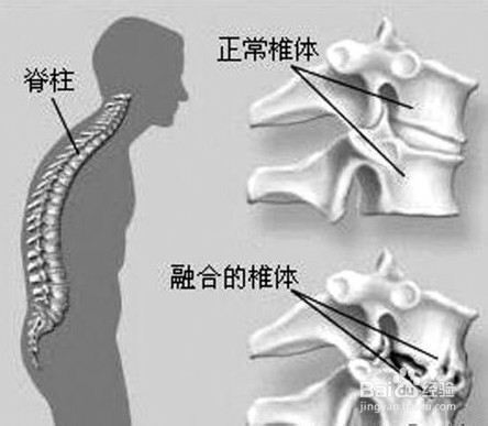 哪些是脊髓损伤的病因