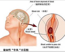 【常识】哪些人易患脑血栓？