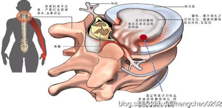 颈椎病形成原因