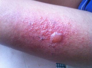 【危害】烧伤对人体的危害程度分析