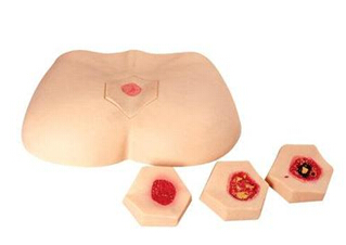 褥疮的临床表现有什么