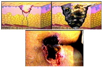 专家是如何对褥疮进行分型的